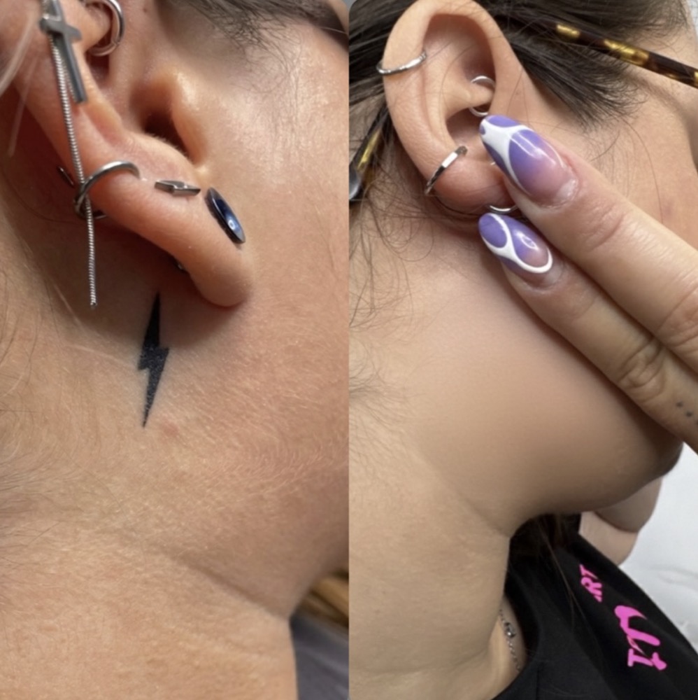 Aclarado láser para cover-up Vitoria-Gasteiz