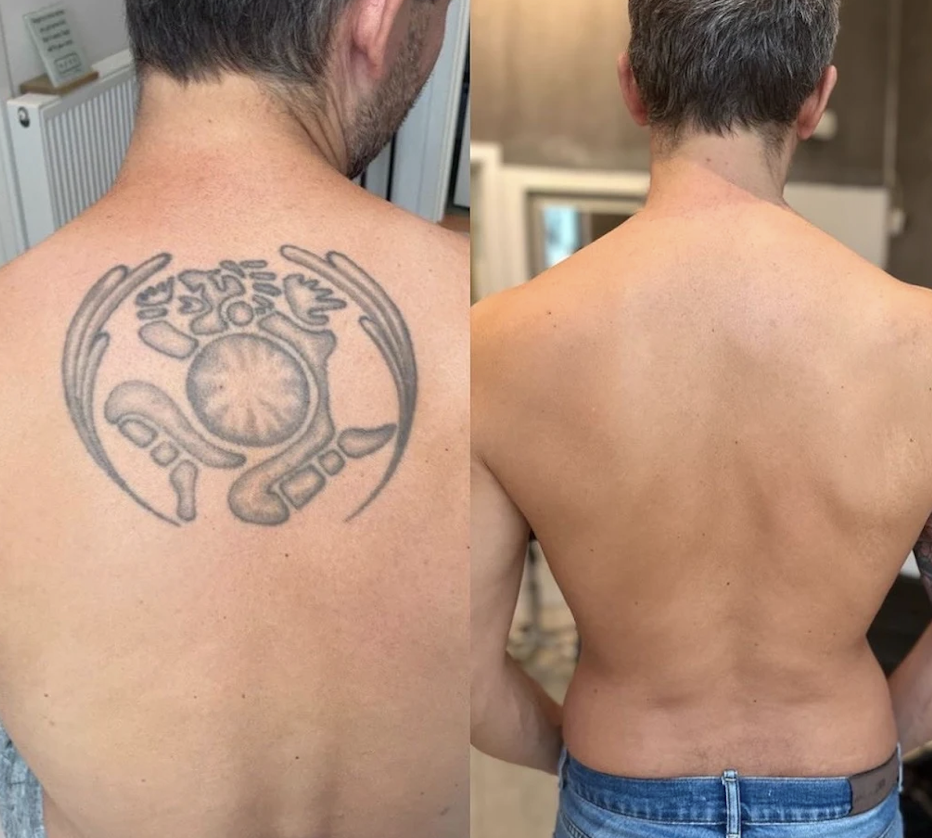 Eliminación láser tatuaje antes y después Vitoria-Gasteiz