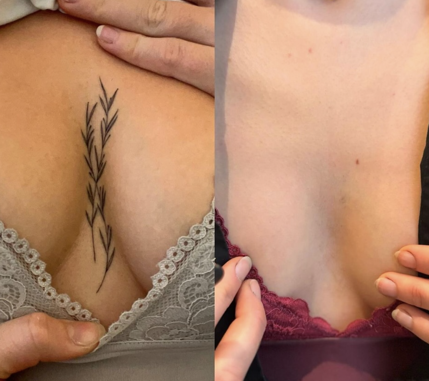 Eliminación láser tatuaje resultado final Vitoria-Gasteiz